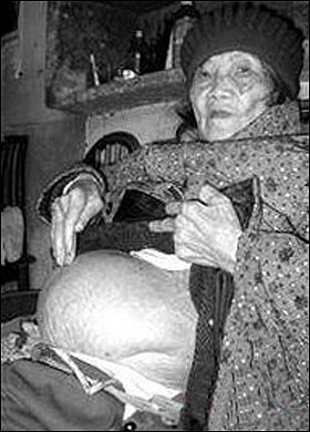 pregnancy